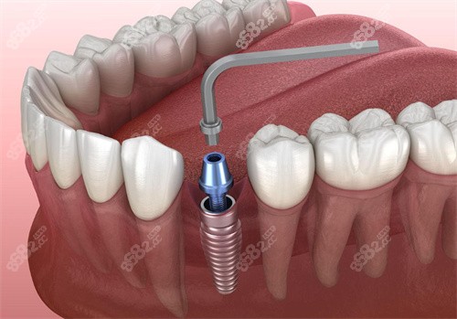 種植牙操作動畫圖片