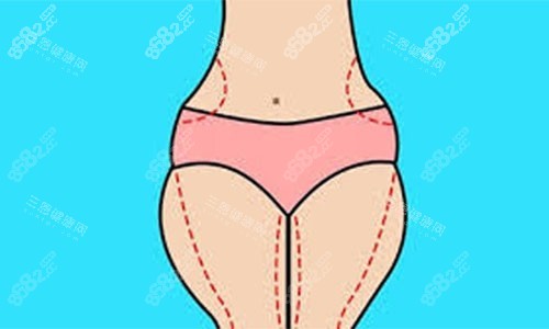 大腿吸脂手術(shù)設(shè)計方案示意圖