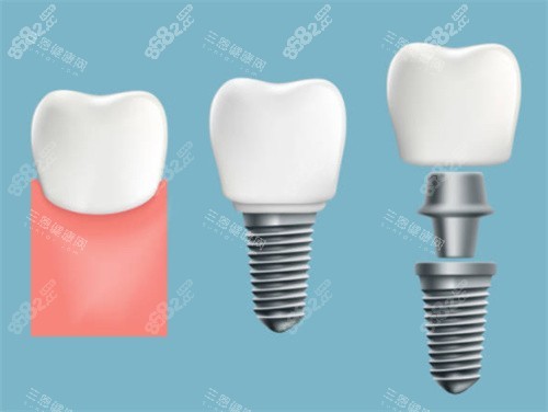 牙齒種植過程圖
