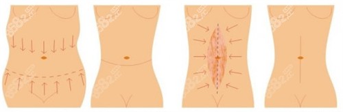 不同程度的腰腹