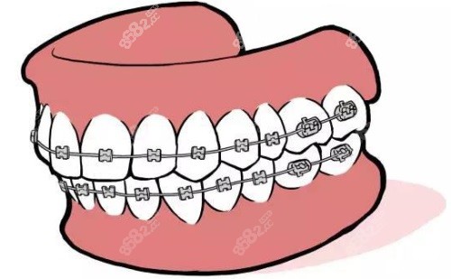 金屬固定矯正示意圖