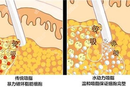 吸脂示意圖
