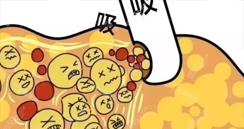 吸脂過程動畫展示圖