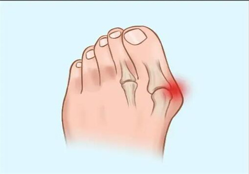 望京醫(yī)院溫建民大夫什么時候出診？權(quán)威骨科專家，解鎖拇外翻治療黃金時間！