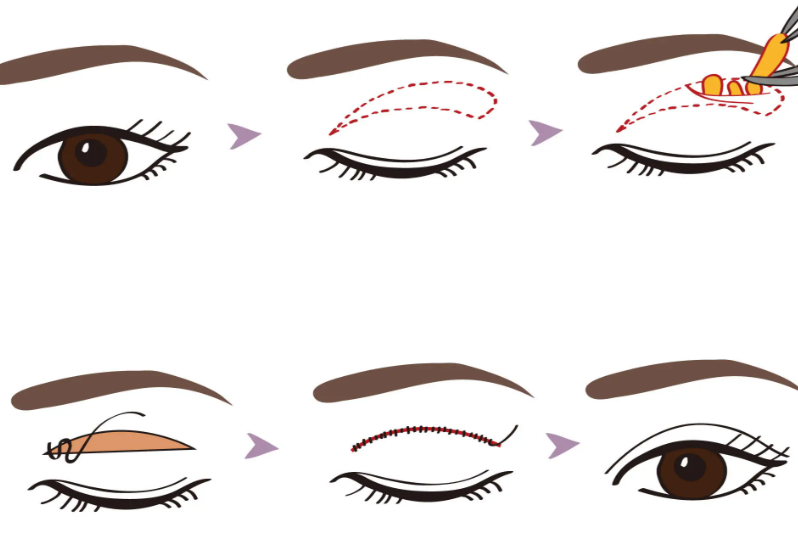 雙眼皮手術(shù)的基本情況