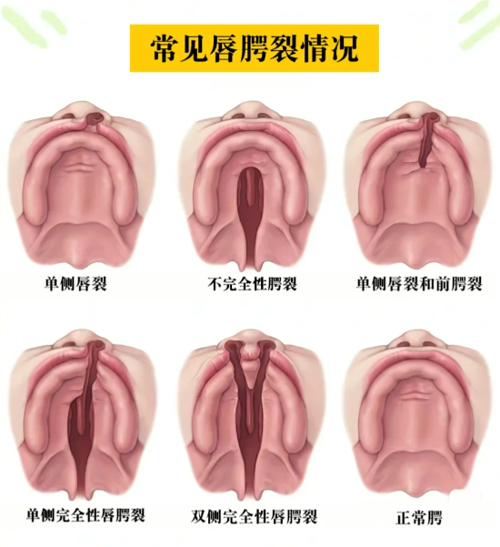 八、如何預約華 西醫(yī)院唇腭裂手術？