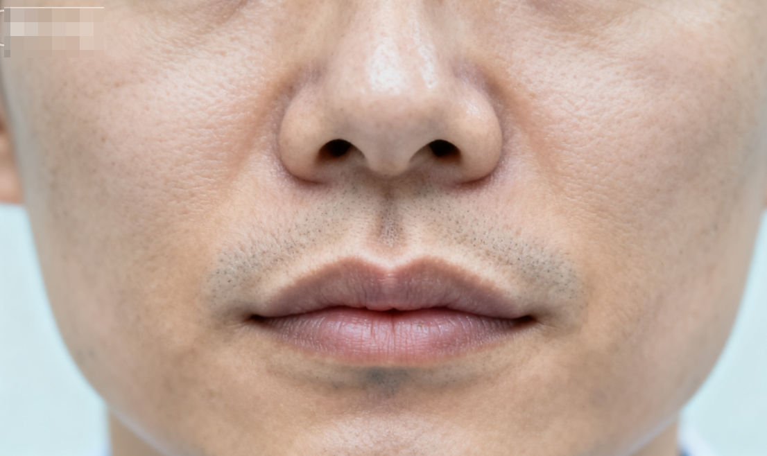 管果醫(yī)生人中縮短的動態(tài)無痕技術核心揭秘（進階減齡的關鍵）