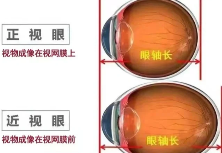 四、泗洪朝聚眼科醫(yī)院近視手術(shù)術(shù)后療效與患者口碑