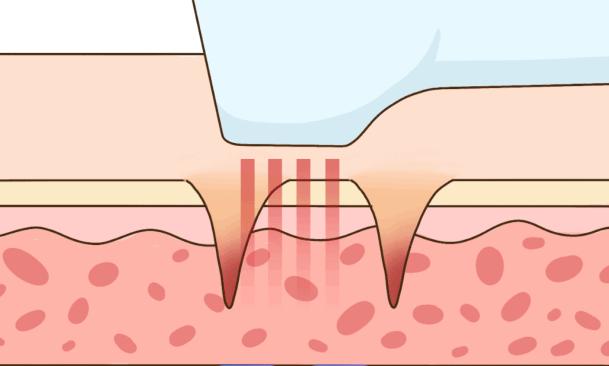 一、大連做點陣激光哪家好中設備高端的選擇：大連高嵐醫(yī)療美容