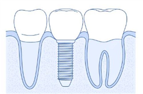 簡單種植牙背景圖