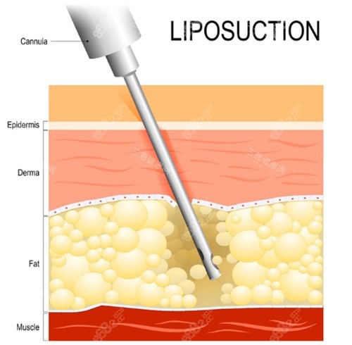 抽脂手術(shù)動畫演示