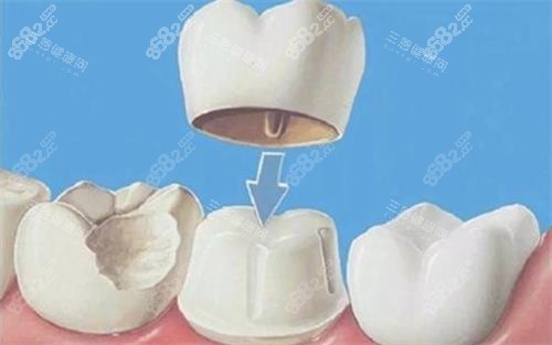 全瓷牙冠安裝