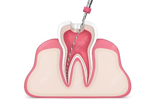 根管治療卡通展示