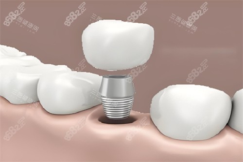 種植牙圖片展示圖片