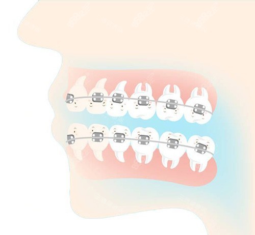 牙齒矯正側(cè)面動(dòng)畫