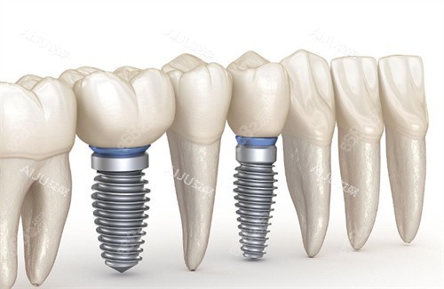 種植牙動(dòng)畫(huà)圖片展示