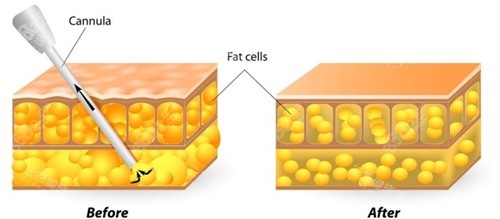 吸脂前后對(duì)比圖示
