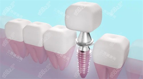 種植牙透視動畫展示圖