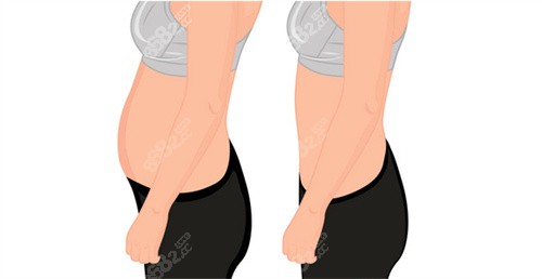 腹部吸脂對比