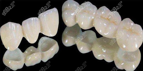 全瓷牙冠示意圖