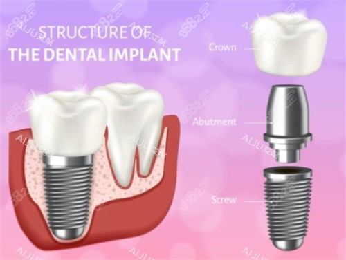 種植牙模擬示意圖