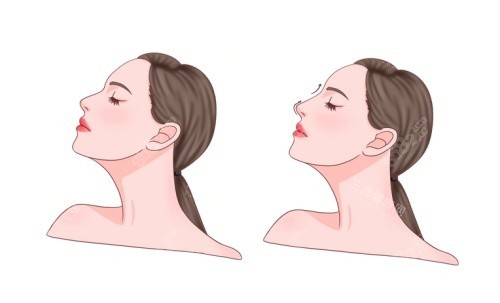 鼻整形術(shù)后示意圖