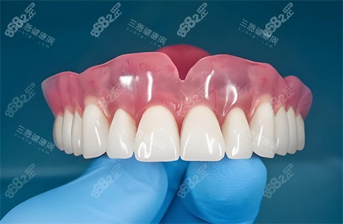 全口種植牙齒圖片