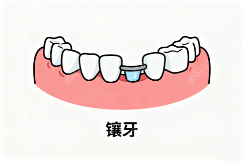 鑲牙卡通圖一覽