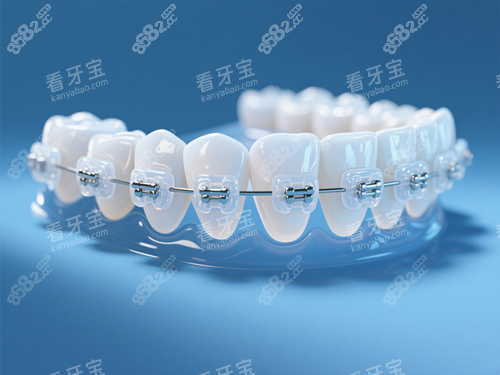 陶瓷托槽牙齒矯正
