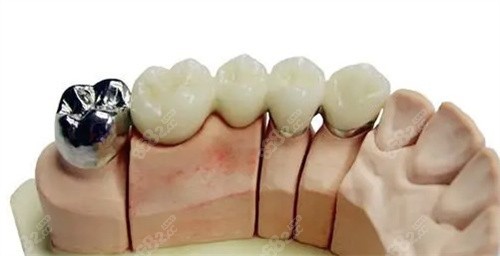 不同種類的烤瓷牙