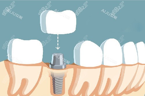 單顆種植牙牙冠安裝漫畫(huà)圖