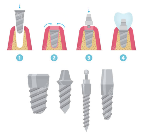 種植牙詳解圖