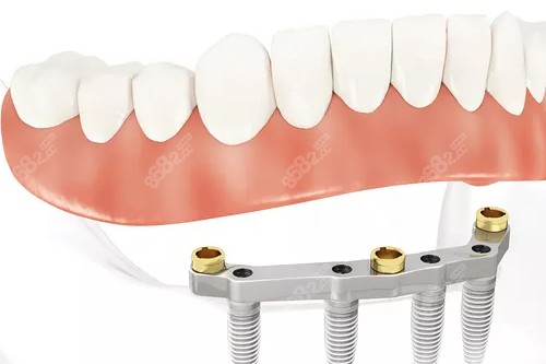 半口種植牙聯(lián)排牙冠示意圖