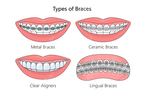 牙齒矯正的不同類型
