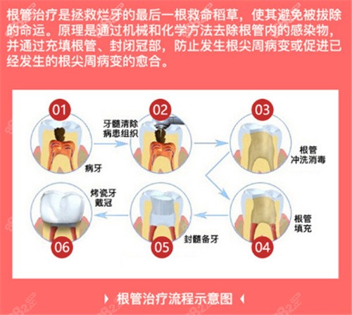 根管治療流程展示