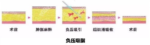 抽脂手術(shù)方式動畫圖