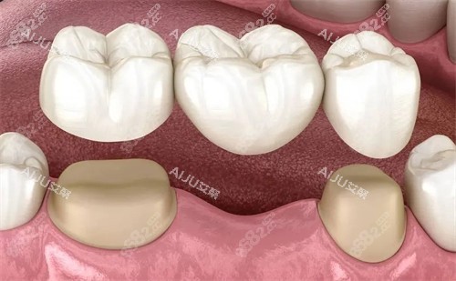 連冠全瓷牙