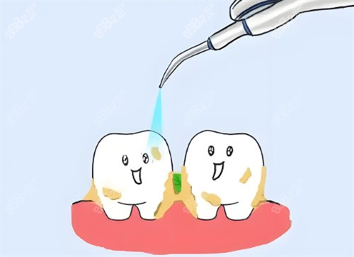 洗牙卡通示意圖片