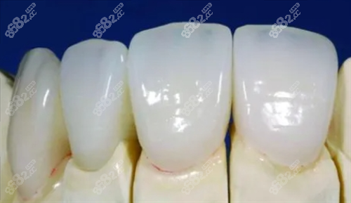 鈀金烤瓷牙牙模型展示