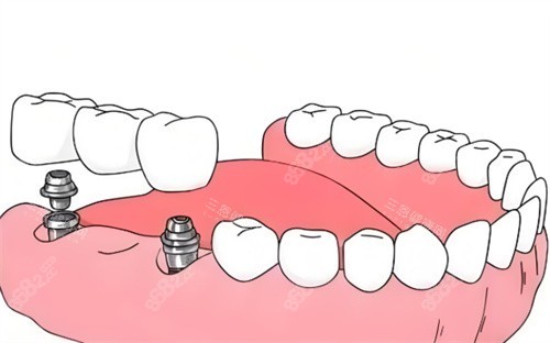 種植牙材料卡通展示圖