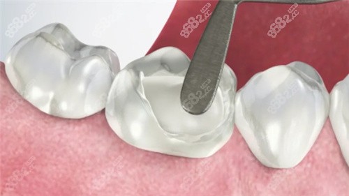 烤瓷牙素材圖