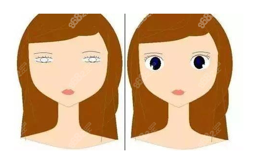 眼皮松弛做雙眼皮對比圖