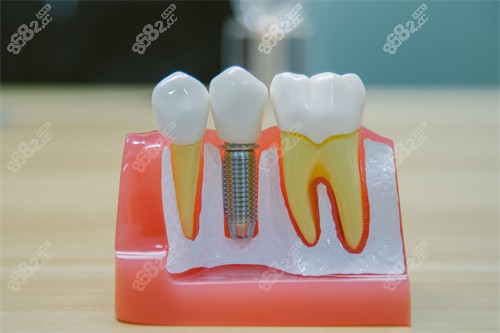 牙科種植牙模型