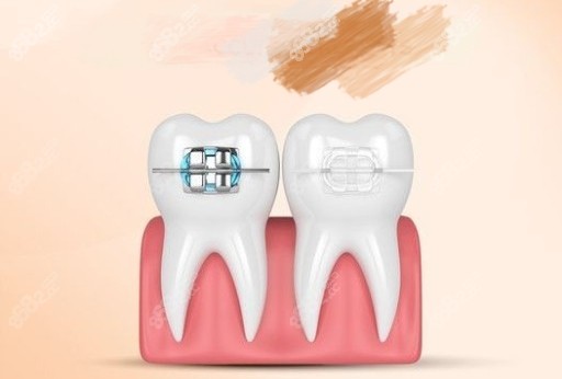 牙齒矯正金屬和陶瓷托槽漫畫圖