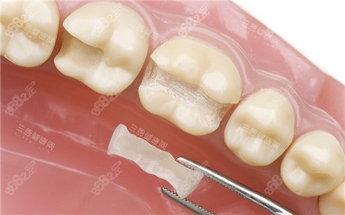 嵌體補牙