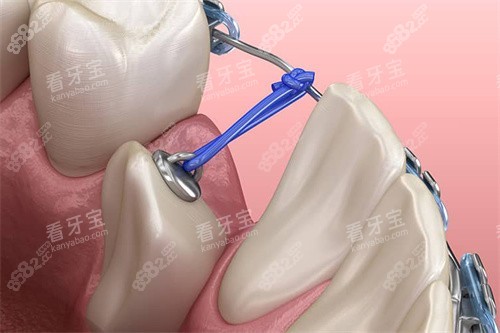 下頜單顆牙齒牽引