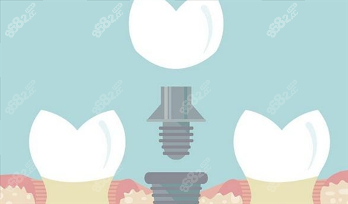 組成種植牙的三部分動畫展示