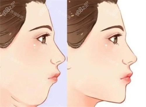 雙下巴抽脂前后對比側(cè)面動畫圖