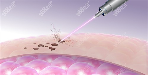 激光改善皮膚斑點