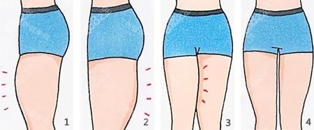 大腿吸脂卡通圖